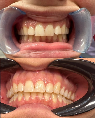 Clear Aligners