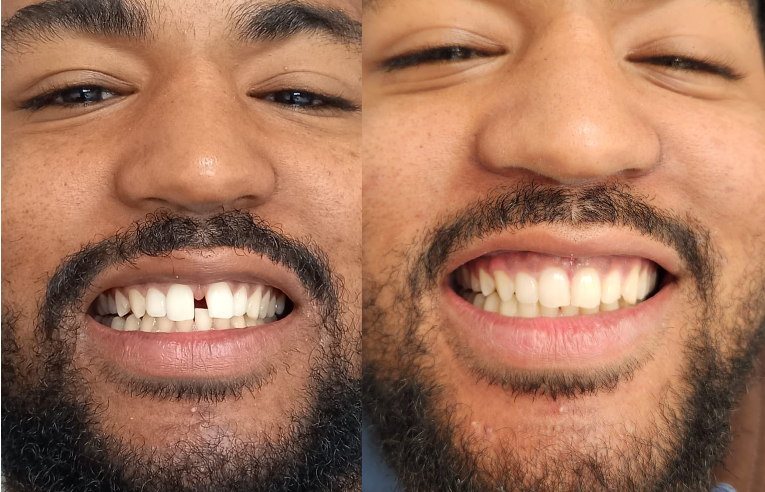 Clear Aligners
