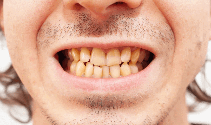 Crowded Teeth